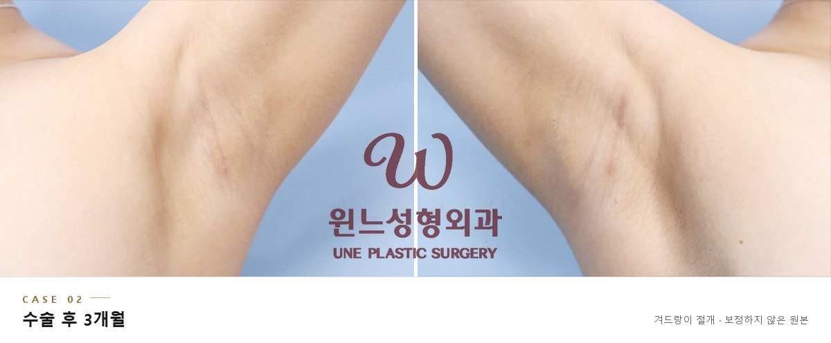 겨드랑이 절개 흉터 CASE 02, 가슴확대 수술 후 3개월 좌우 겨드랑이 (보정하지 않은 원본)