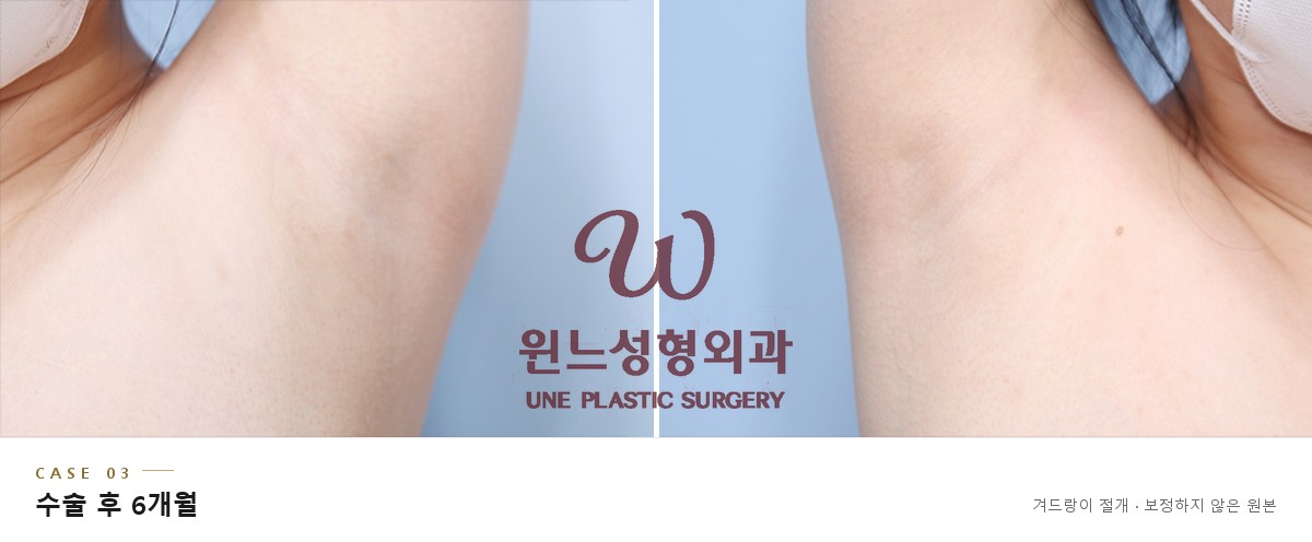 겨드랑이 절개 흉터 CASE 03, 가슴확대 수술 후 6개월 좌우 겨드랑이 (보정하지 않은 원본)
