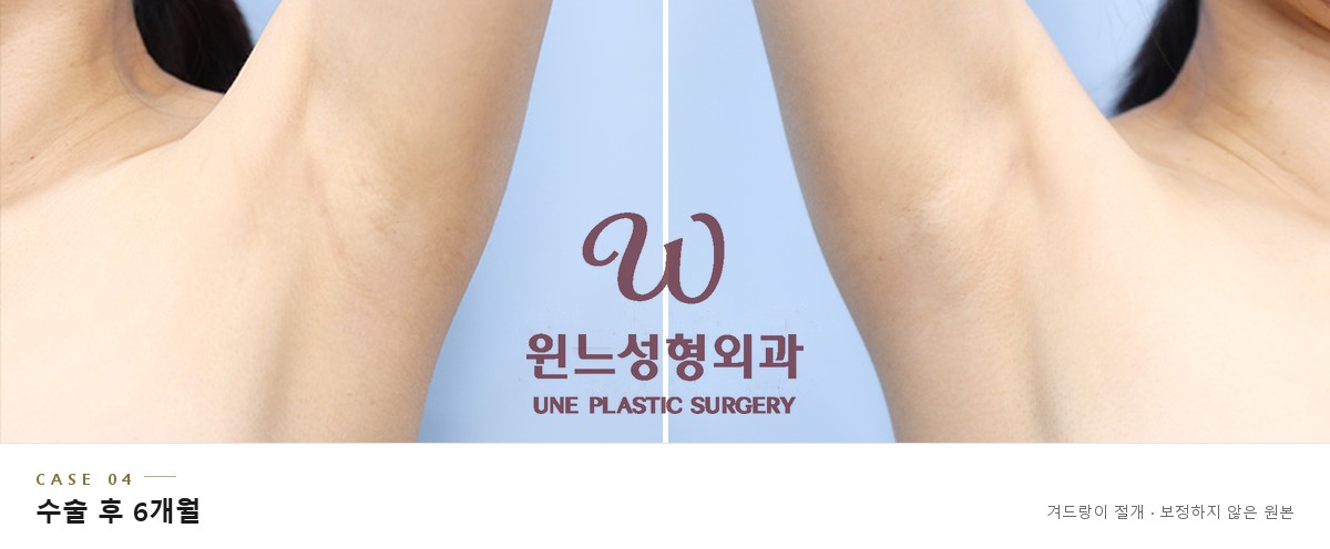 겨드랑이 절개 흉터 CASE 04, 가슴확대 수술 후 6개월 좌우 겨드랑이 (보정하지 않은 원본)