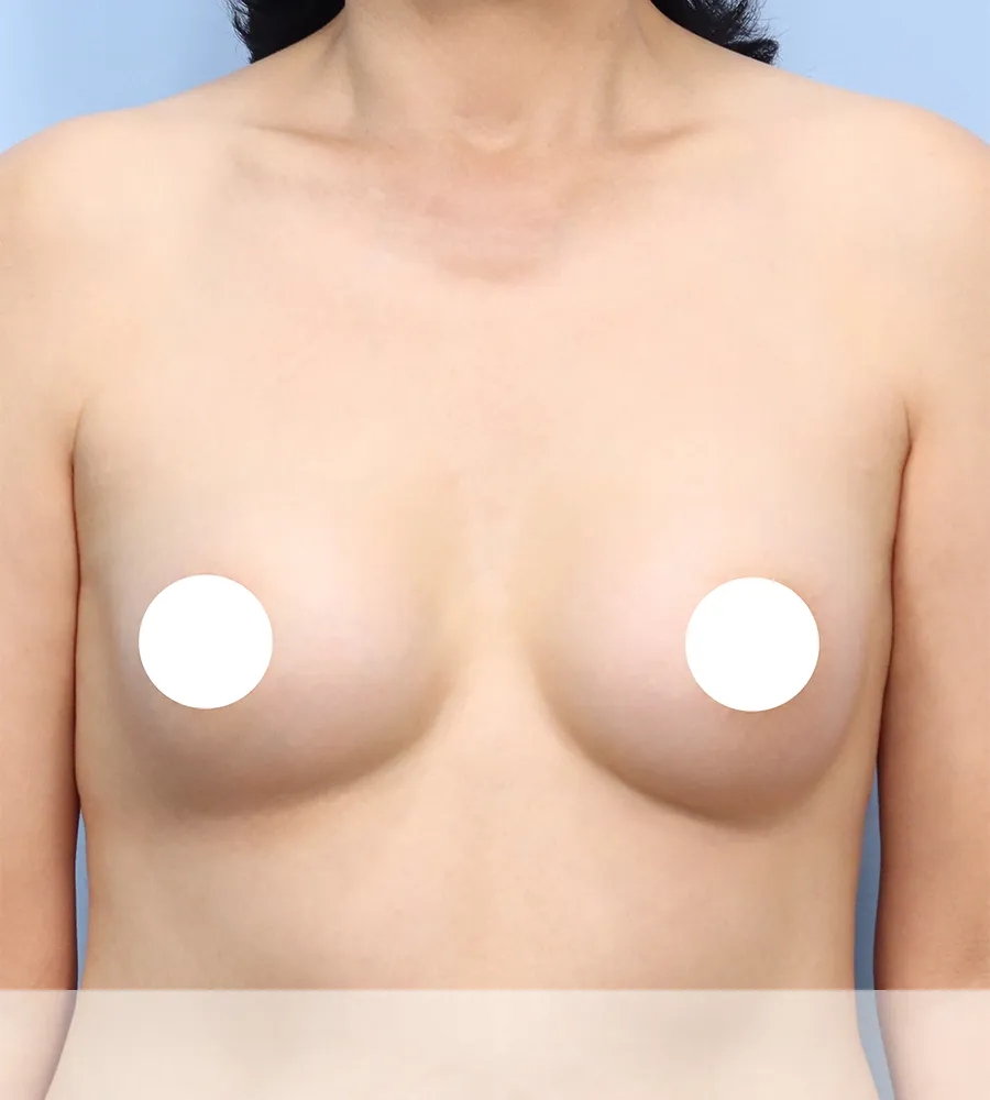 가슴확대 수술 케이스 스터디 1 - 윈느성형외과 Breast Augmentation Case Study 1