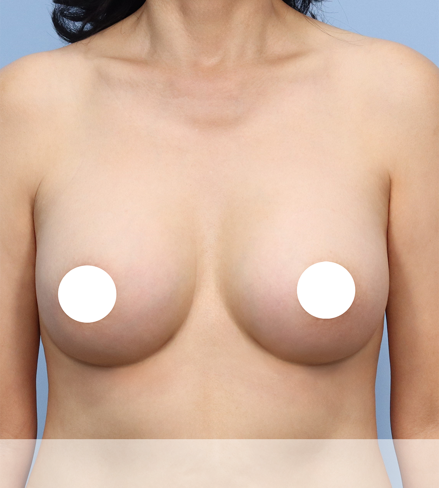 가슴확대 수술 케이스 스터디 2 - 윈느성형외과 Breast Augmentation Case Study 2
