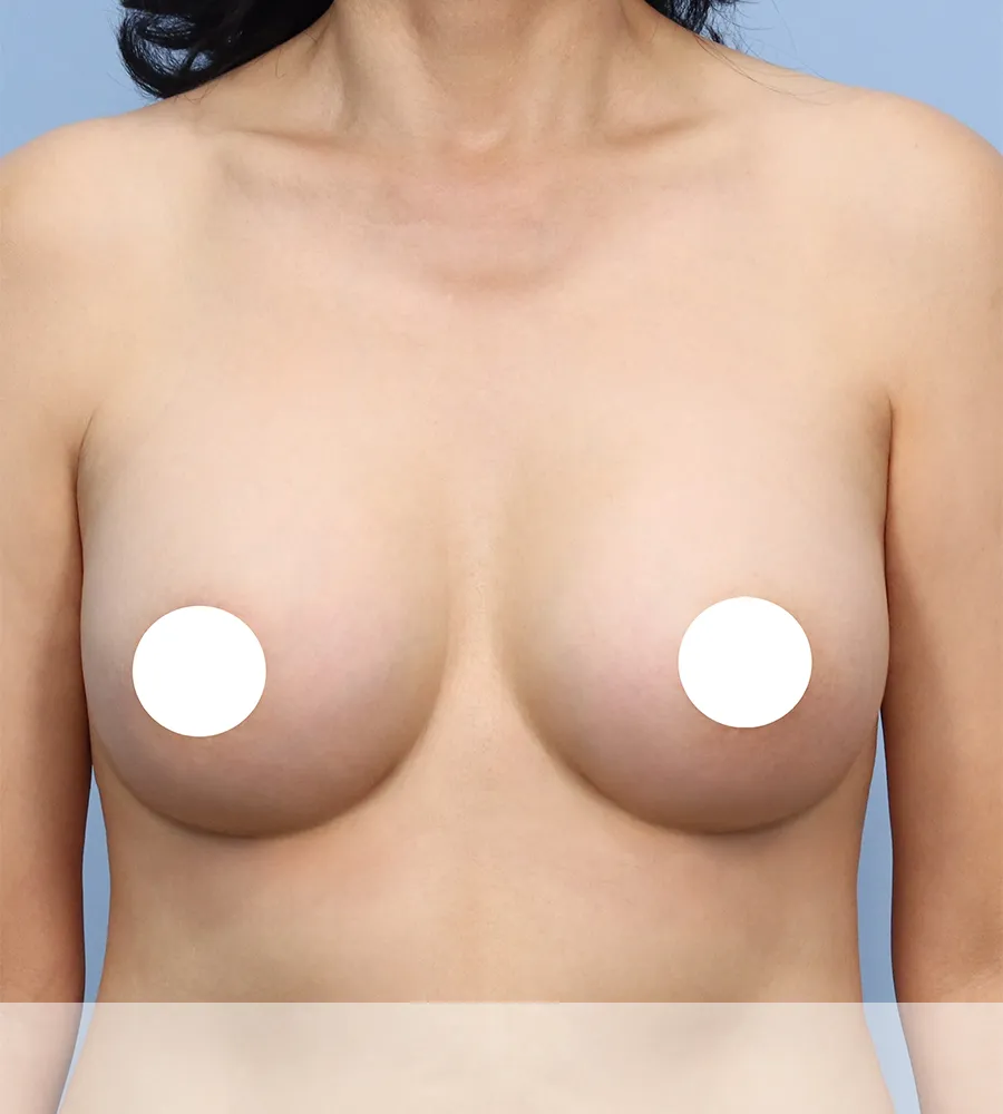 가슴확대 수술 케이스 스터디 2 - 윈느성형외과 Breast Augmentation Case Study 2
