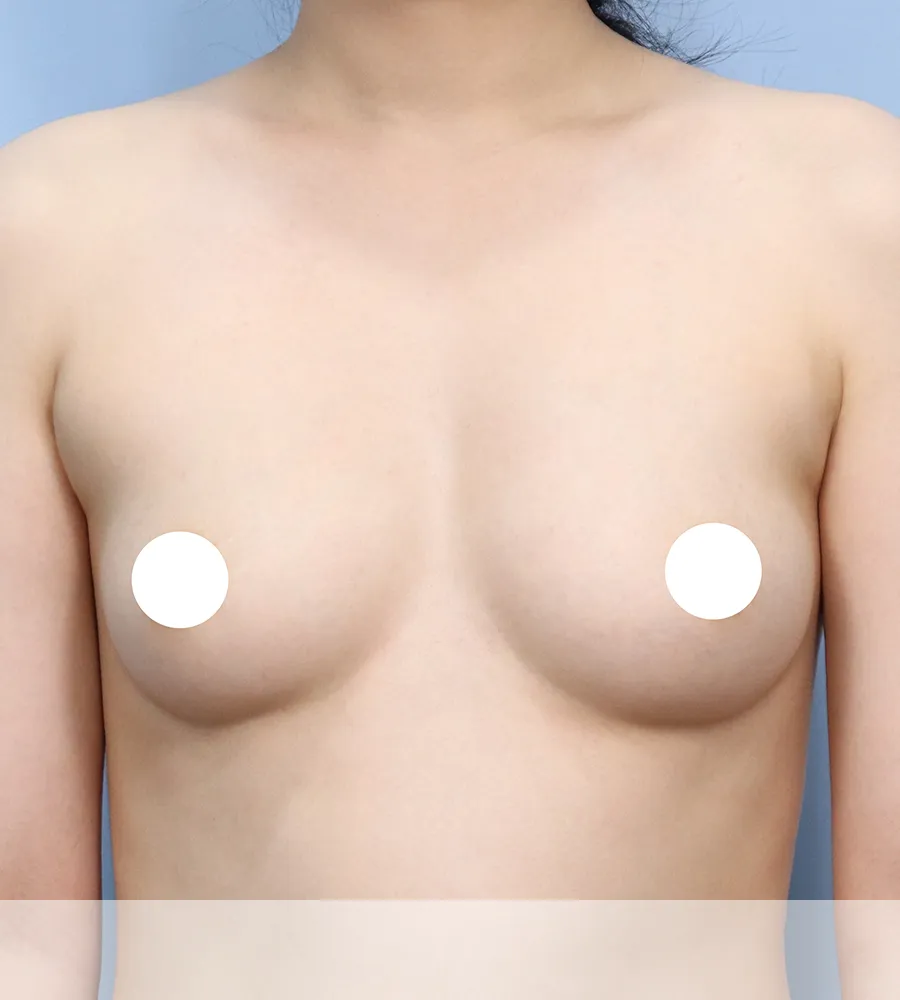 가슴확대 수술 케이스 스터디 3 - 윈느성형외과 Breast Augmentation Case Study 3