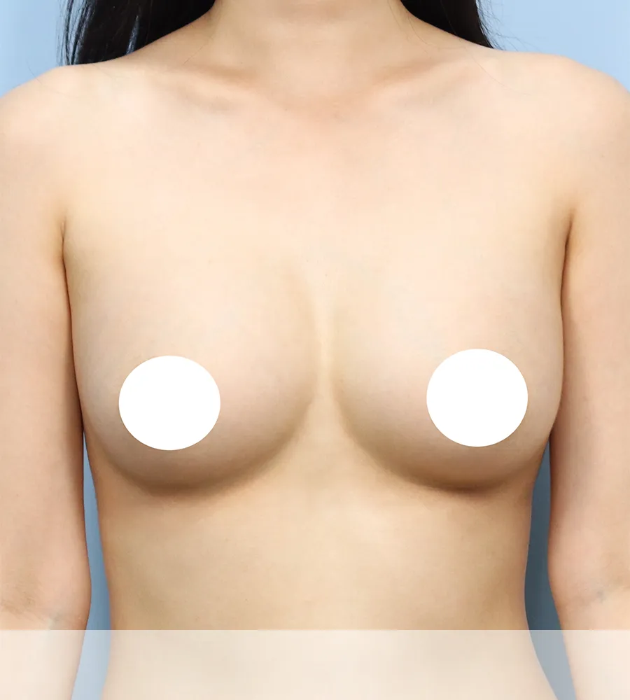 가슴확대 수술 케이스 스터디 10 - 윈느성형외과 Breast Augmentation Case Study 10