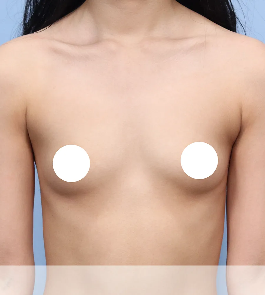 가슴확대 수술 케이스 스터디 11 - 윈느성형외과 Breast Augmentation Case Study 11