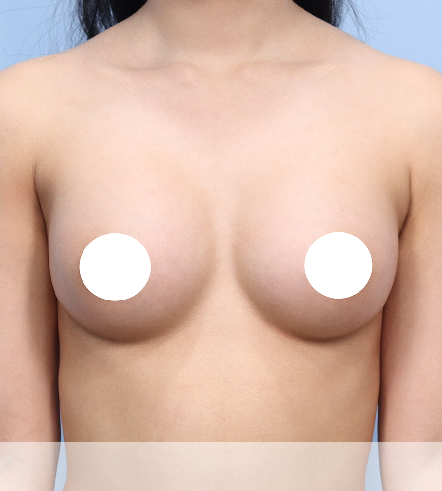 가슴확대 수술 케이스 스터디 12 - 윈느성형외과 Breast Augmentation Case Study 12