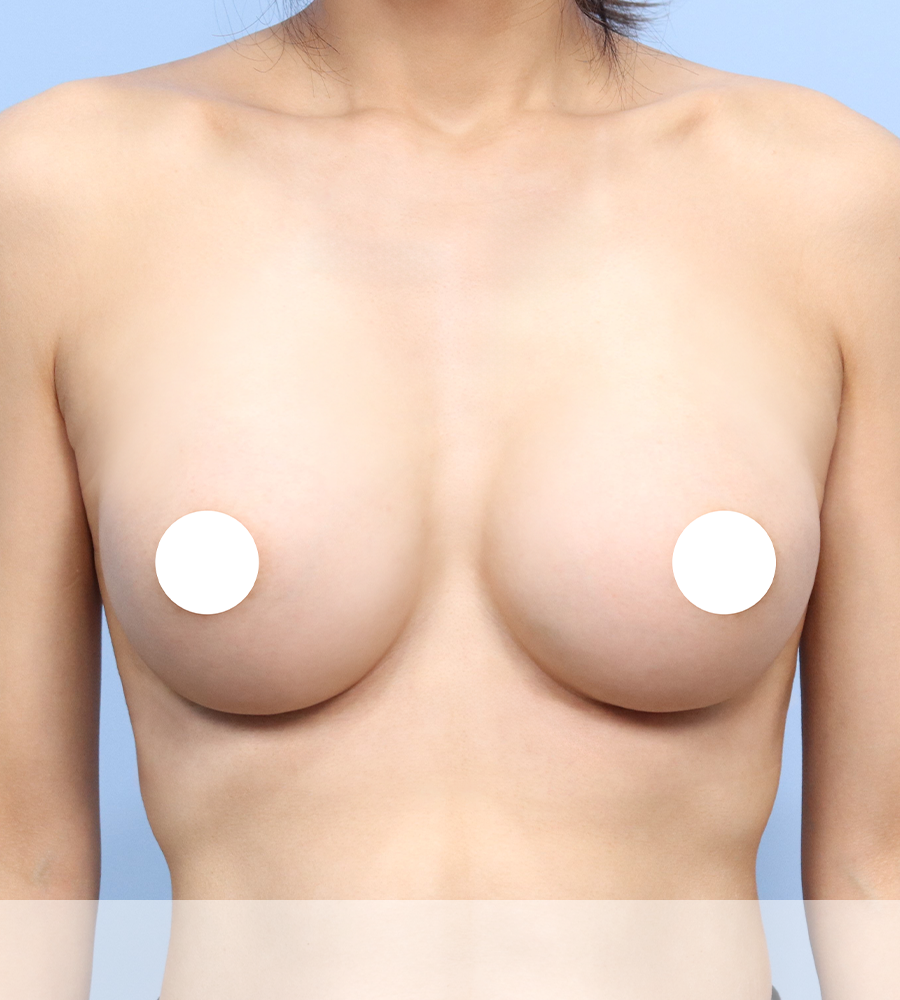 가슴확대 수술 케이스 스터디 14 - 윈느성형외과 Breast Augmentation Case Study 14