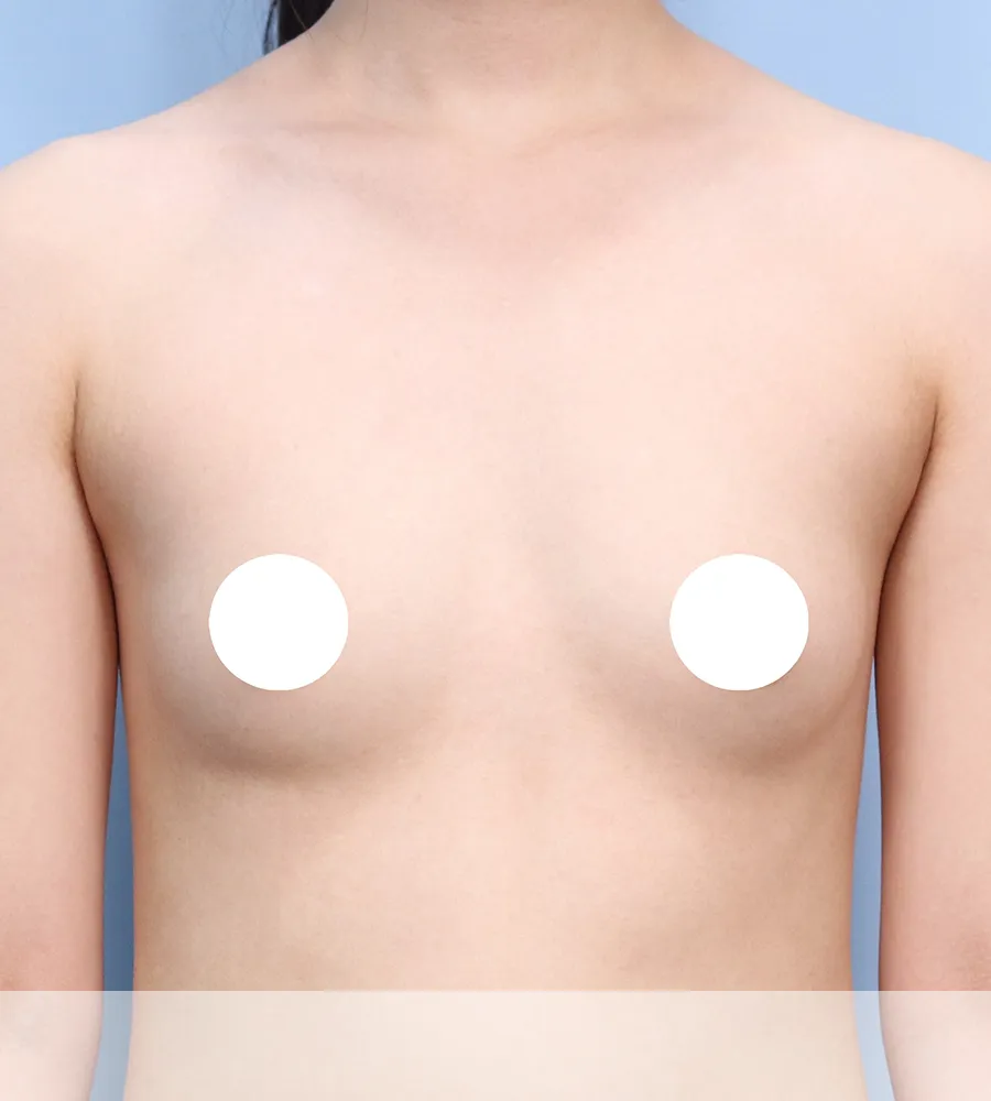 가슴확대 수술 케이스 스터디 15 - 윈느성형외과 Breast Augmentation Case Study 15