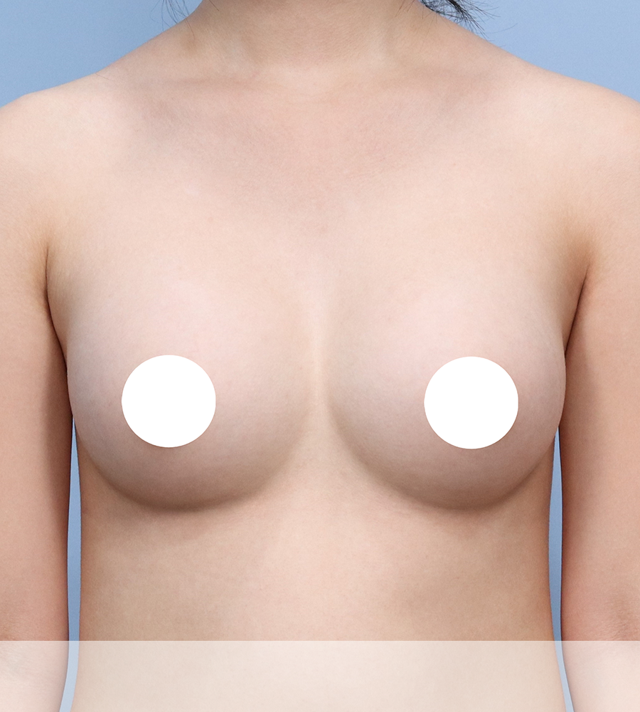 가슴확대 수술 케이스 스터디 16 - 윈느성형외과 Breast Augmentation Case Study 16