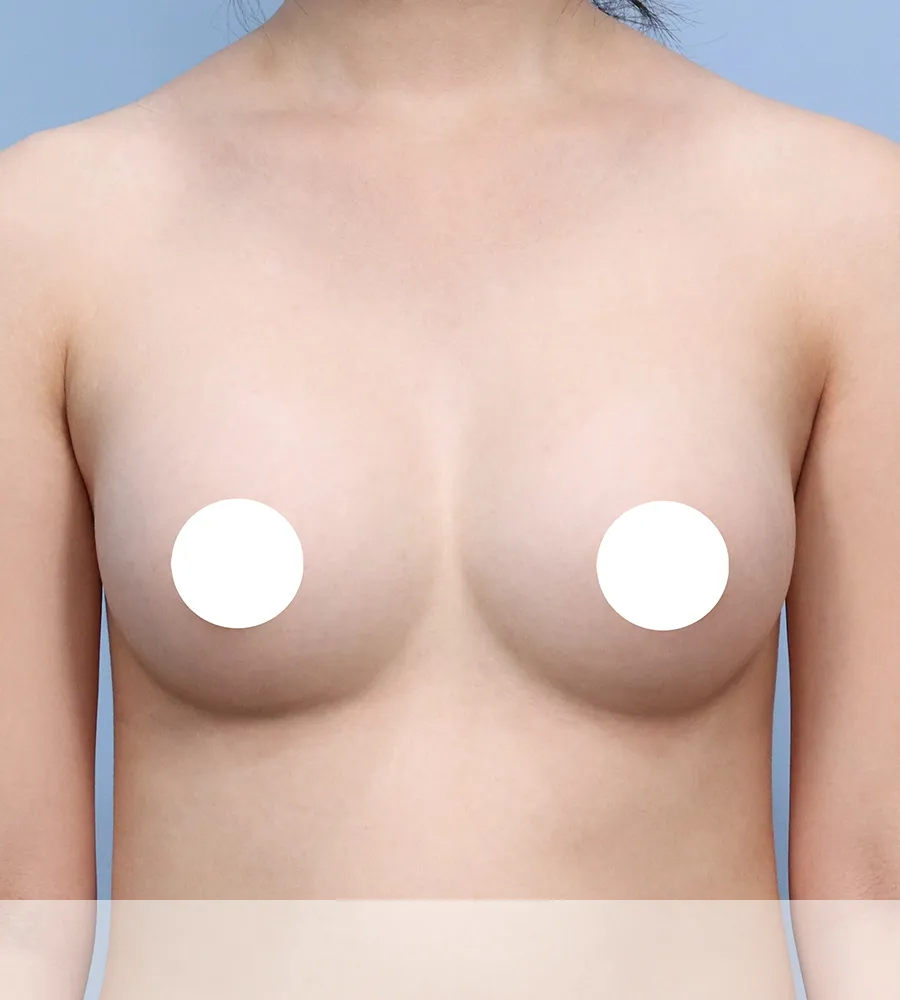 가슴확대 수술 케이스 스터디 16 - 윈느성형외과 Breast Augmentation Case Study 16