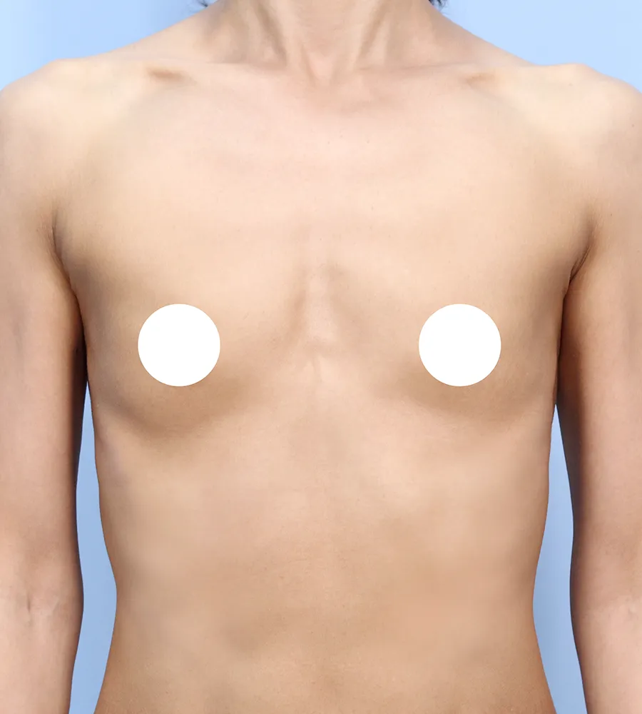가슴확대 수술 케이스 스터디 22 - 윈느성형외과 Breast Augmentation Case Study 22