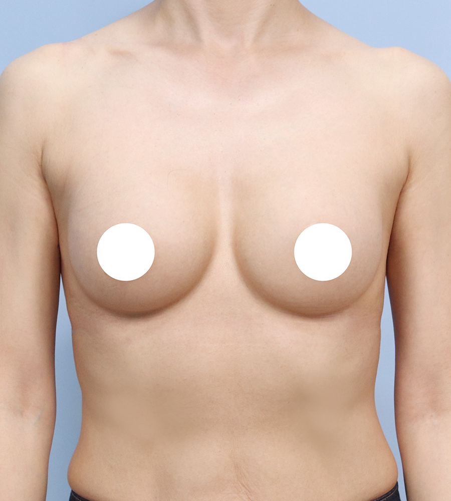 가슴확대 수술 케이스 스터디 23 - 윈느성형외과 Breast Augmentation Case Study 23