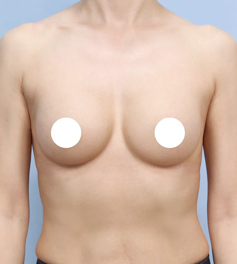 가슴확대 수술 케이스 스터디 23 - 윈느성형외과 Breast Augmentation Case Study 23