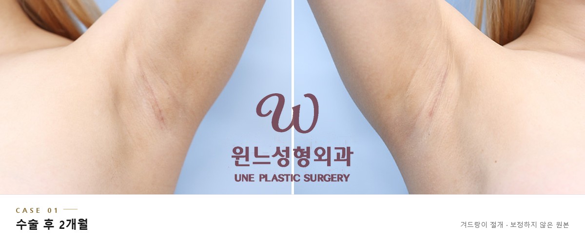 겨드랑이 절개 흉터 CASE 01, 가슴확대 수술 후 2개월 좌우 겨드랑이 (보정하지 않은 원본)
