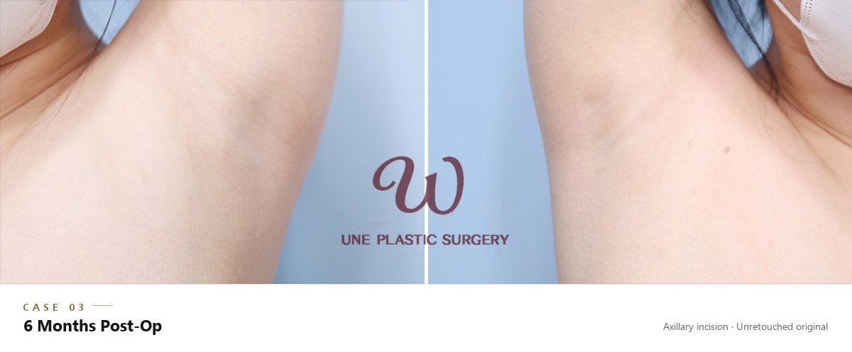 Axillary incision scar CASE 03, both underarms 6 months after breast augmentation (unretouched original)