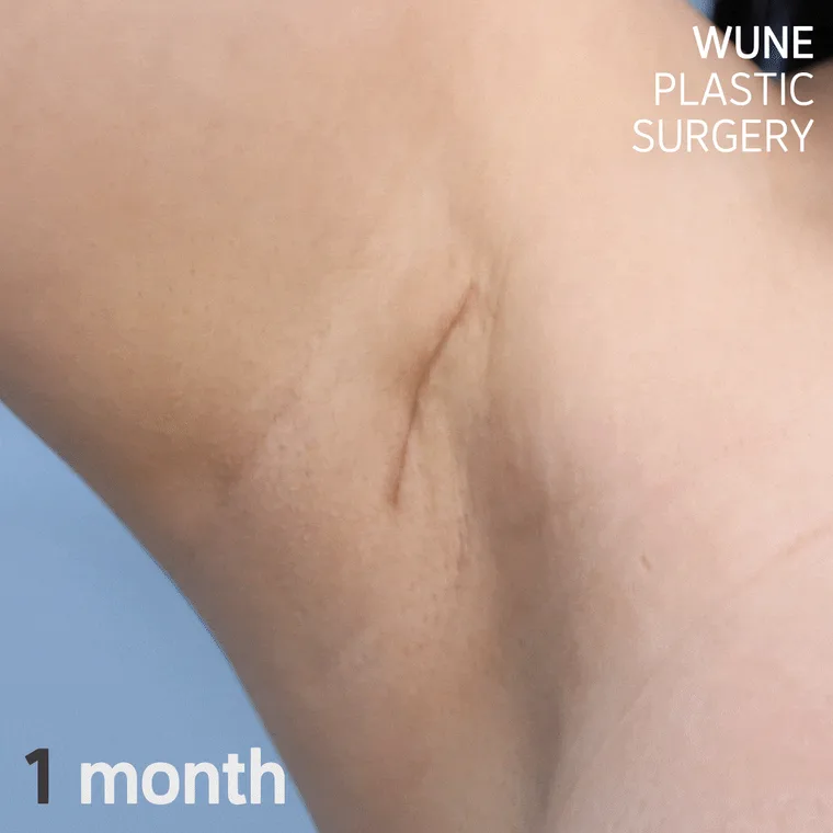 隆胸手术 Surgery Animation