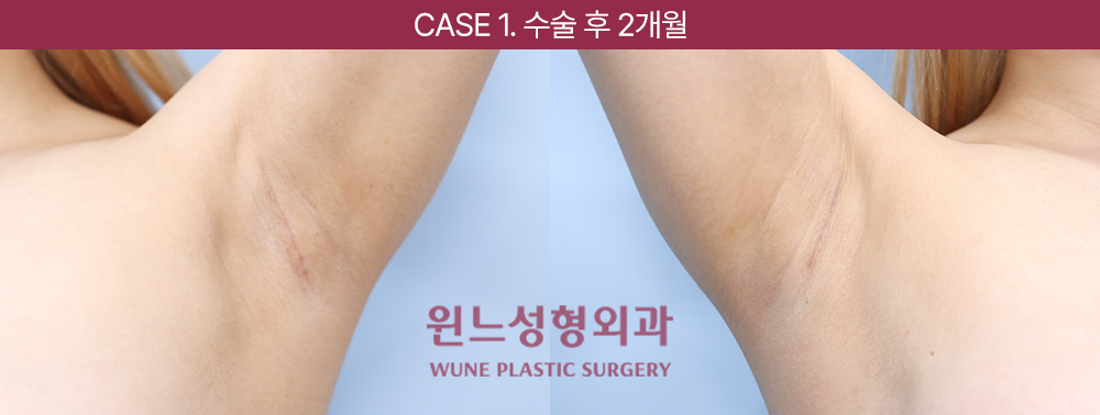 UNE Breast Surgery Technique — Precise Dissection