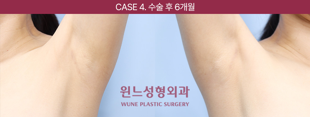 UNE Surgery Suturing Technique
