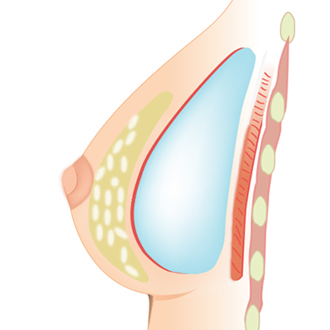 Subfascial Implant Placement Method