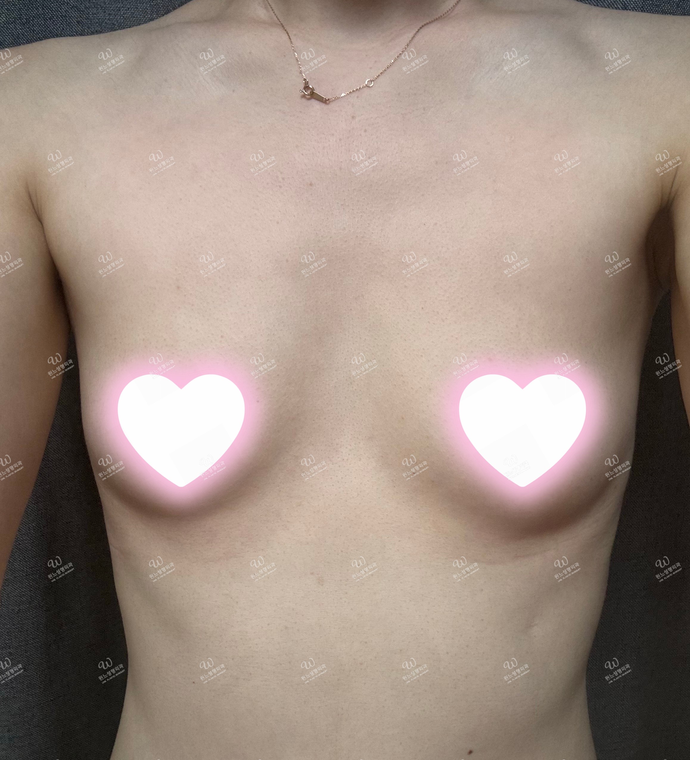 รีวิวเสริมหน้าอก UNE Plastic Surgery [3 เดือน] รีวิว 3 เดือนหลังเสริมหน้าอกที่ UNE