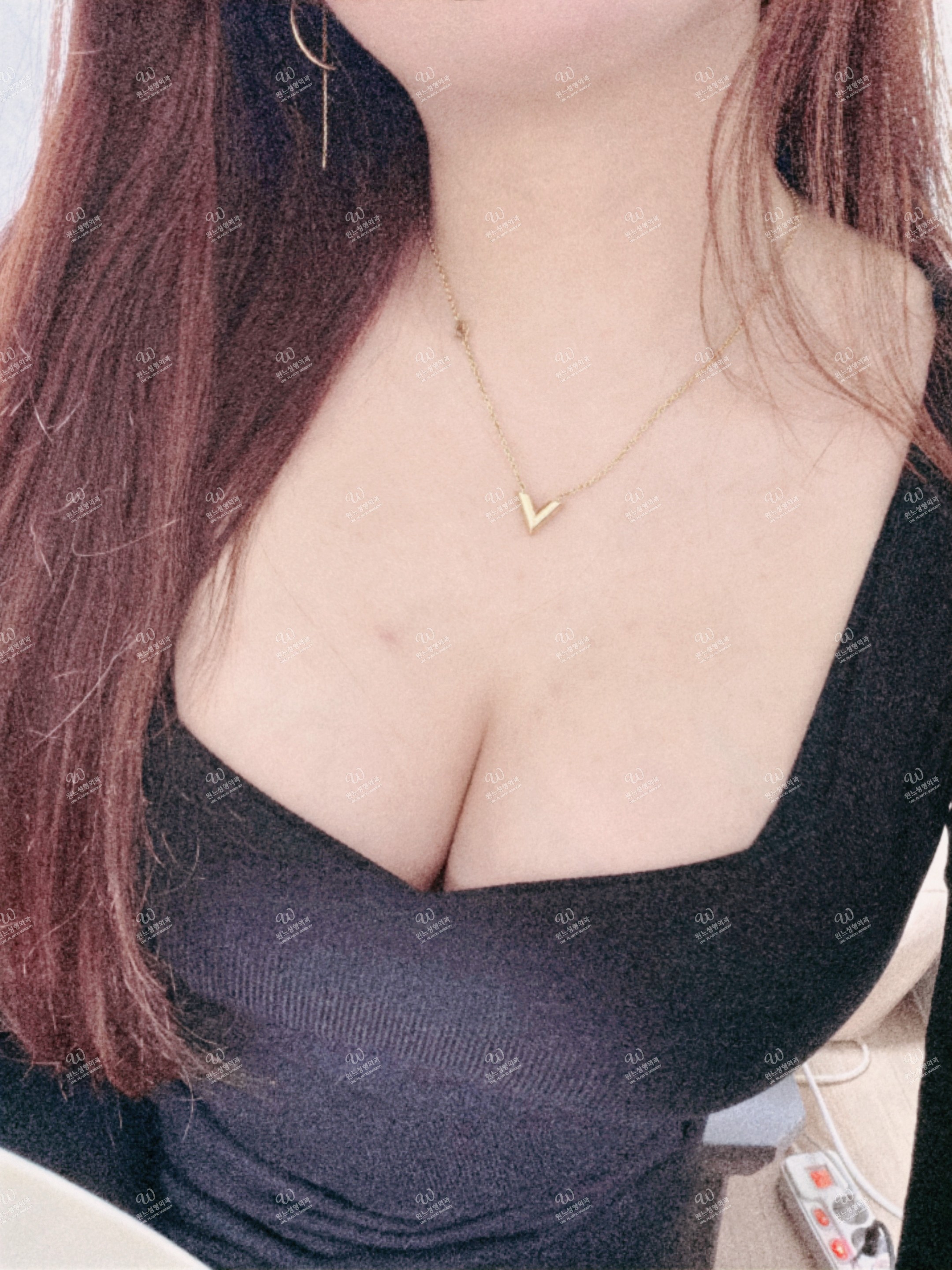 รีวิวเสริมหน้าอก UNE Plastic Surgery [4 เดือน] UNE Plastic Surgery / ผ่าตัดหน้าอกครบ 4 เดือน