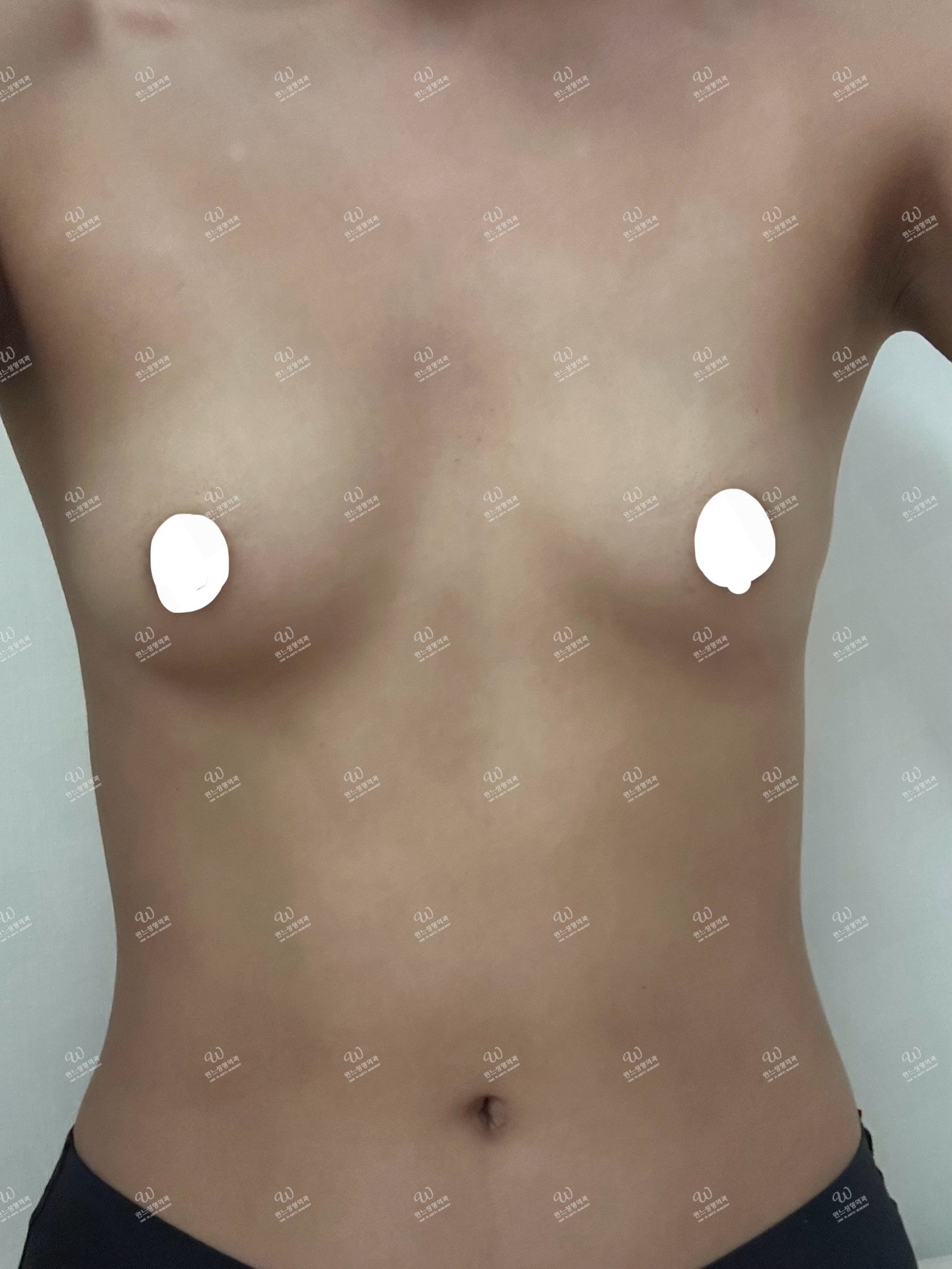 รีวิวเสริมหน้าอก UNE Plastic Surgery [3 เดือน] UNE Plastic Surgery ครบ 3 เดือน