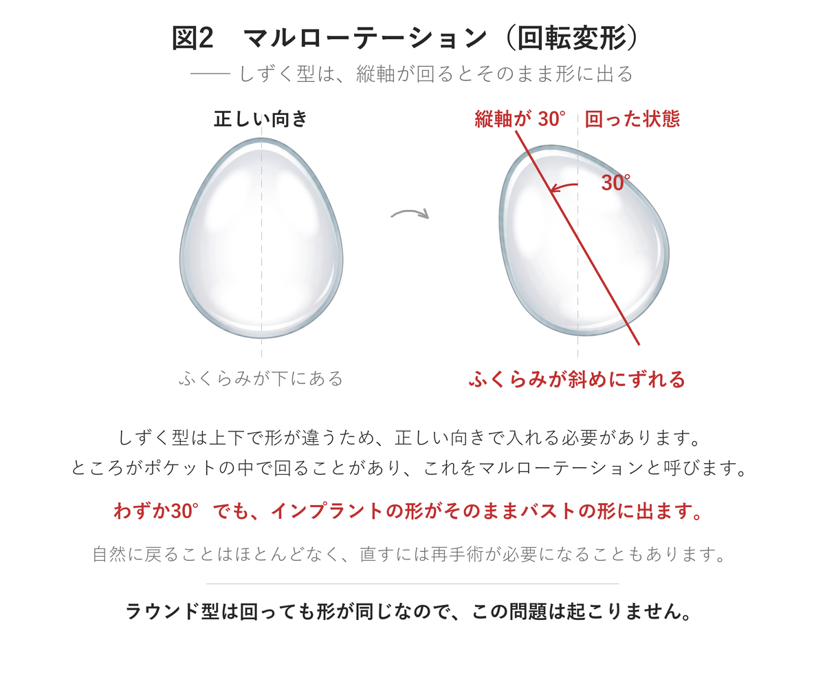 しずく型インプラントのマルローテーション(回転変形)|UNE美容外科