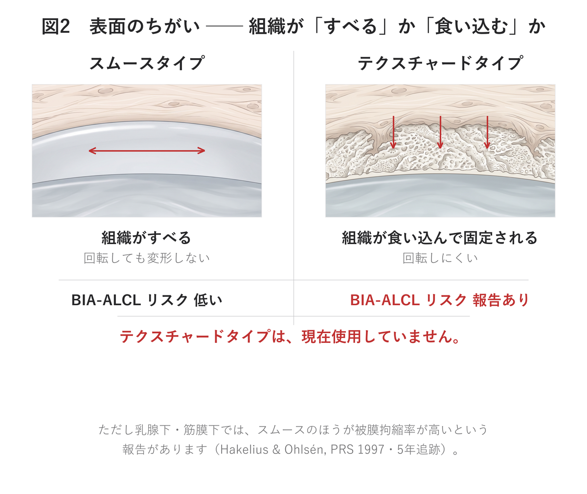 インプラント表面のスムースタイプとテクスチャードタイプの違いとBIA-ALCL|UNE美容外科