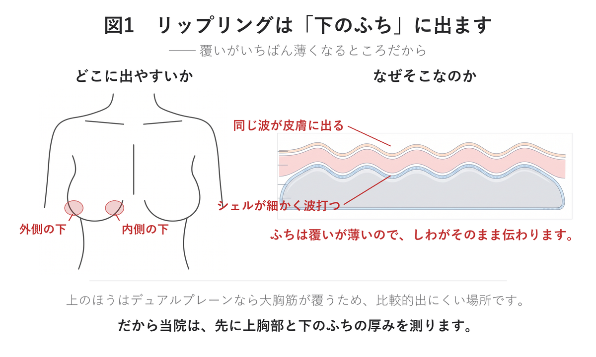 リップリングが出やすい場所(内側の下・外側の下)とシェルのしわが皮膚に伝わる仕組み|UNE美容外科