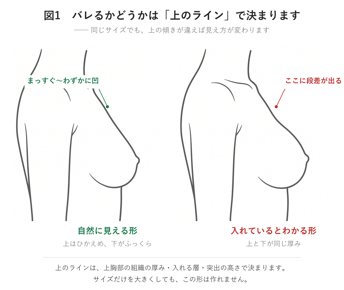 豊胸でバレる形とバレない形―上胸部のラインの違い｜UNE美容外科