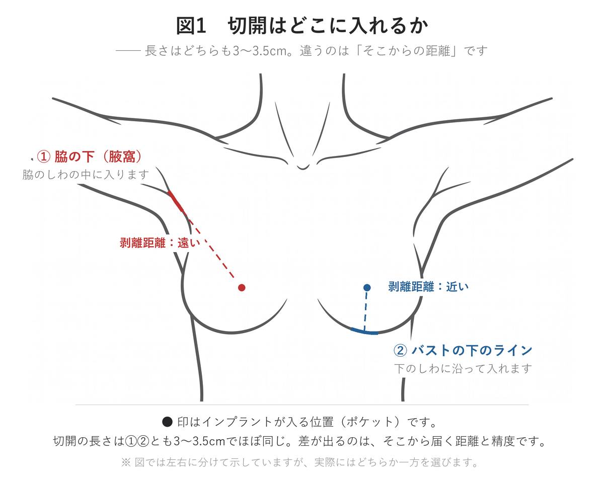 豊胸の切開位置 — 腋窩(脇の下)と乳房下溝(バストの下のライン)、剥離距離の違い|UNE美容外科
