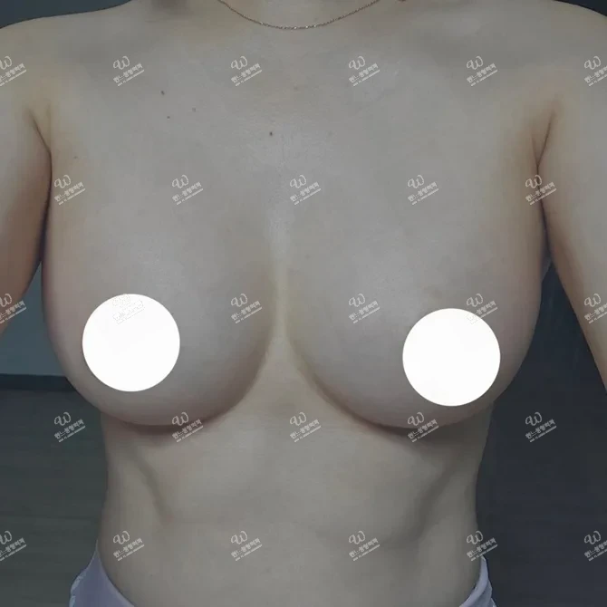가슴수술후기 - 가슴성형 2개월 후기 — 원래 내 가슴 같은 자연스러움 완성