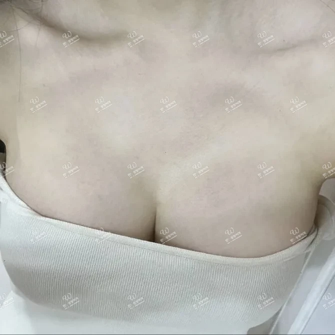 Motiva (魔滴) 450cc 隆胸 术后1个月评价 thumbnail