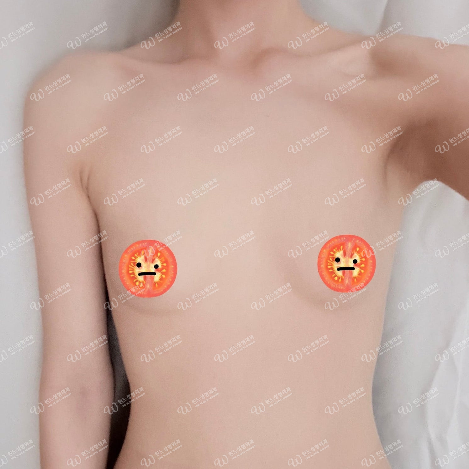가슴성형 수술 전 모습 가슴성형 수술 전 모습