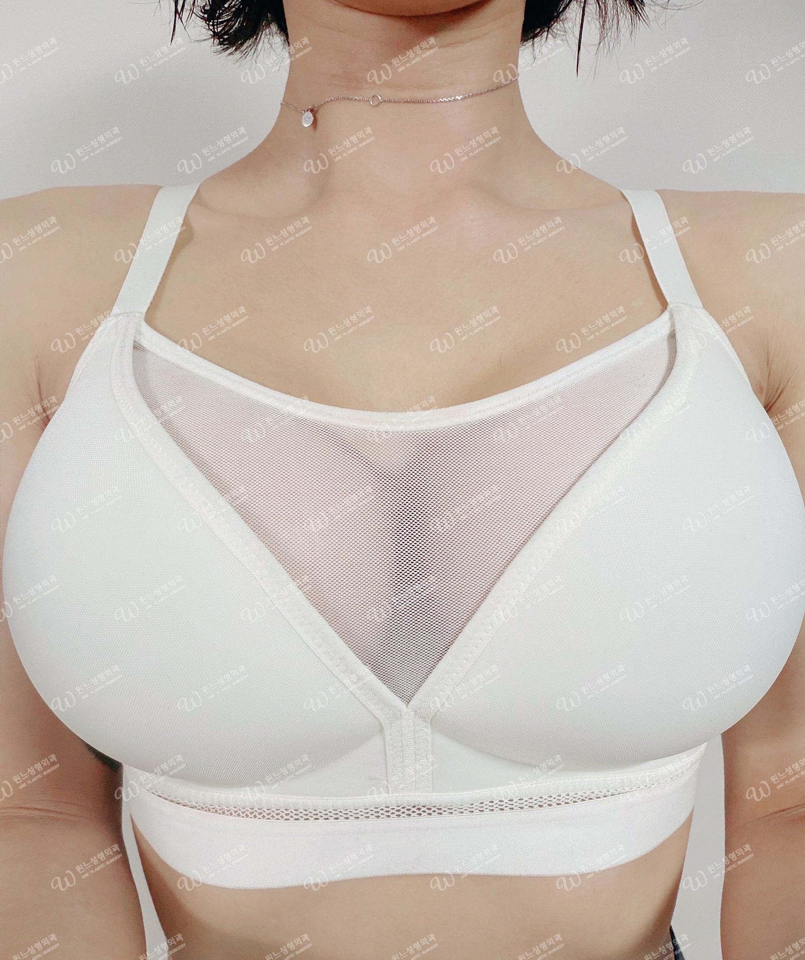 비대칭·처짐 확대만으로 교정, 가슴성형 1달차 후기 | 윈느 성형외과 김의건 원장님