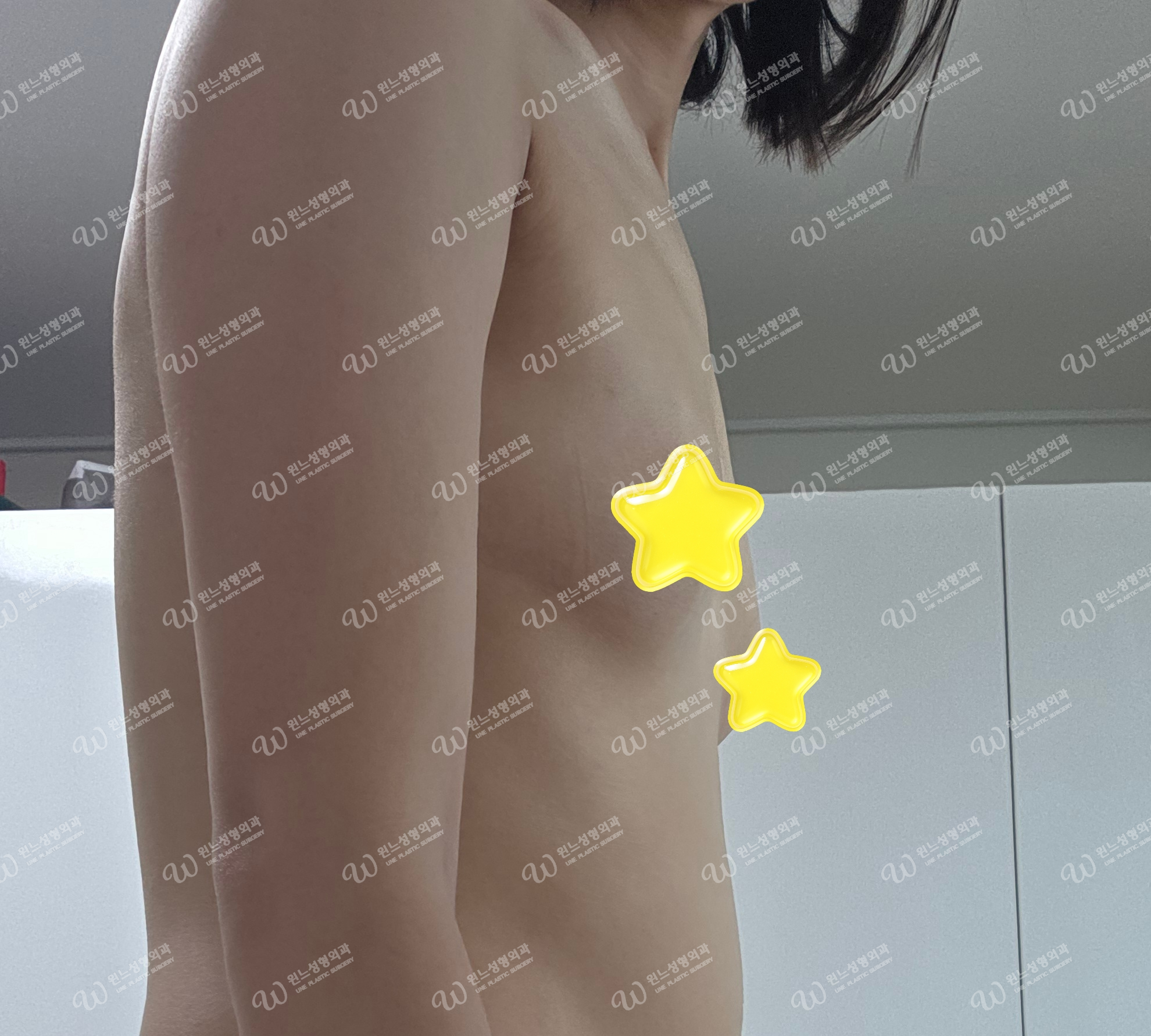 ภาพด้านหน้าก่อนเสริมหน้าอกที่ UNE Plastic Surgery