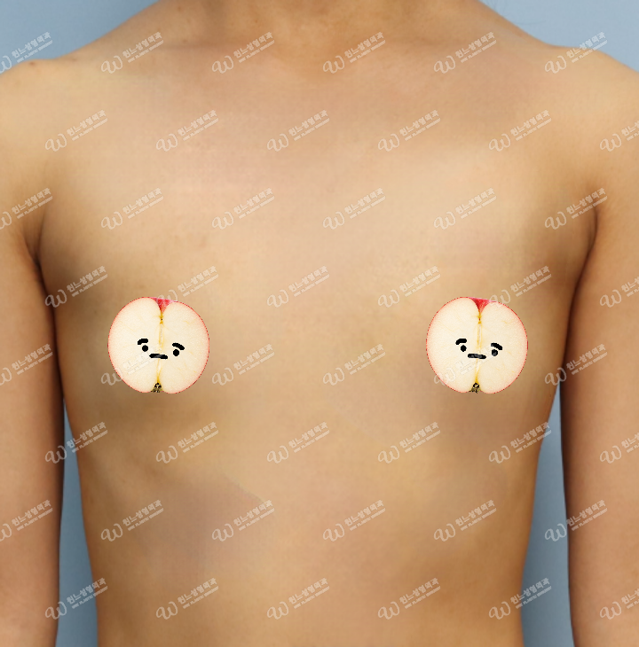 UNE Plastic Surgery ก่อนเสริมหน้าอก
