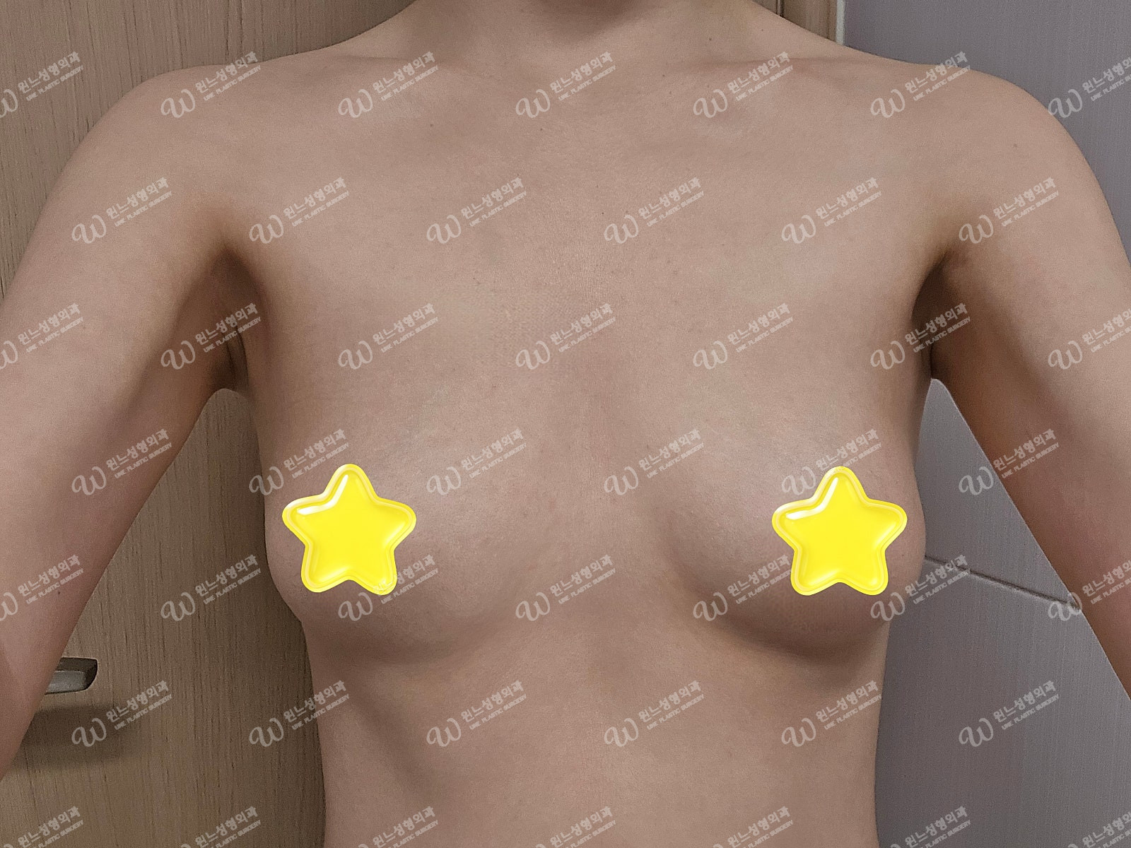 UNE Plastic Surgery ภาพด้านหน้าก่อนเสริมหน้าอก UNE Plastic Surgery ภาพด้านหน้าก่อนเสริมหน้าอก