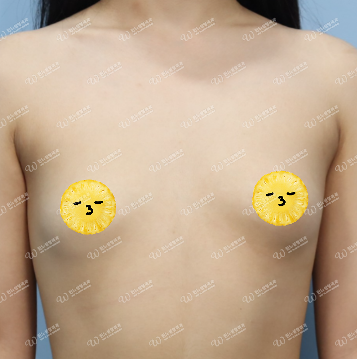 ภาพก่อนเสริมหน้าอกที่ UNE Plastic Surgery ภาพก่อนเสริมหน้าอกที่ UNE Plastic Surgery