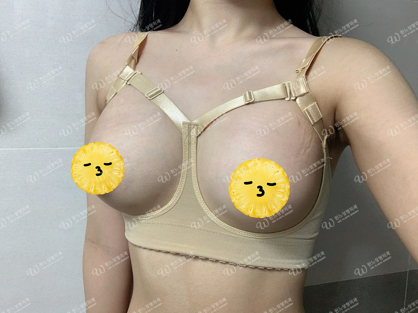 ภาพ 10 วันหลังเสริมหน้าอกที่ UNE Plastic Surgery ภาพ 10 วันหลังเสริมหน้าอกที่ UNE Plastic Surgery