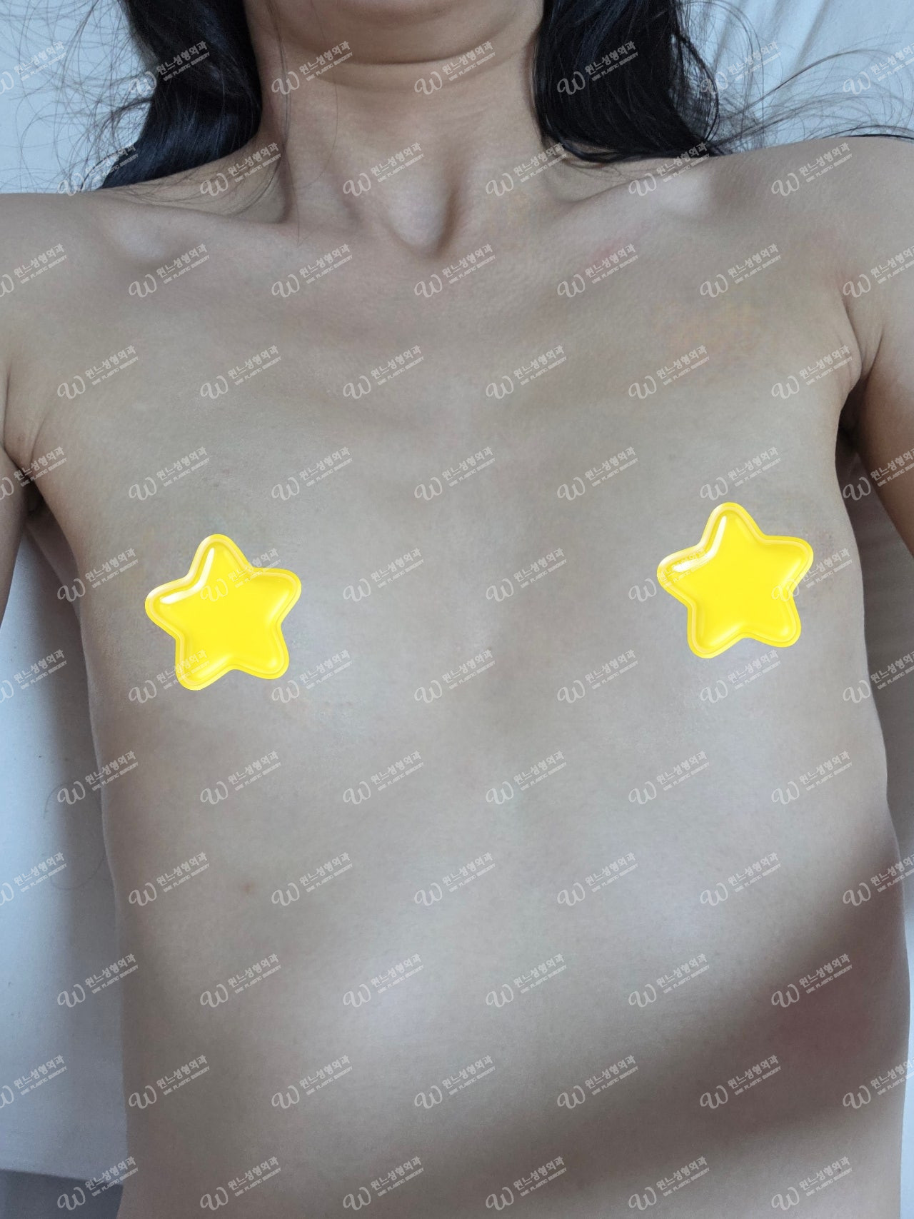 가슴성형 3개월차 자연스러운 모양 가슴성형 3개월차 자연스러운 모양