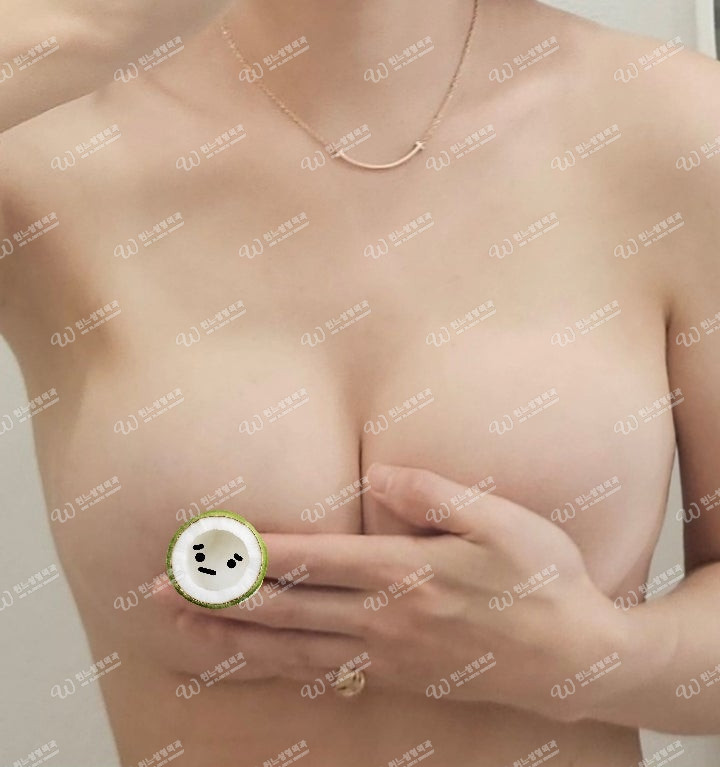 윈느성형외과 가슴성형 1달차 수술 후 정면 사진 윈느성형외과 가슴성형 1달차 수술 후 정면 사진