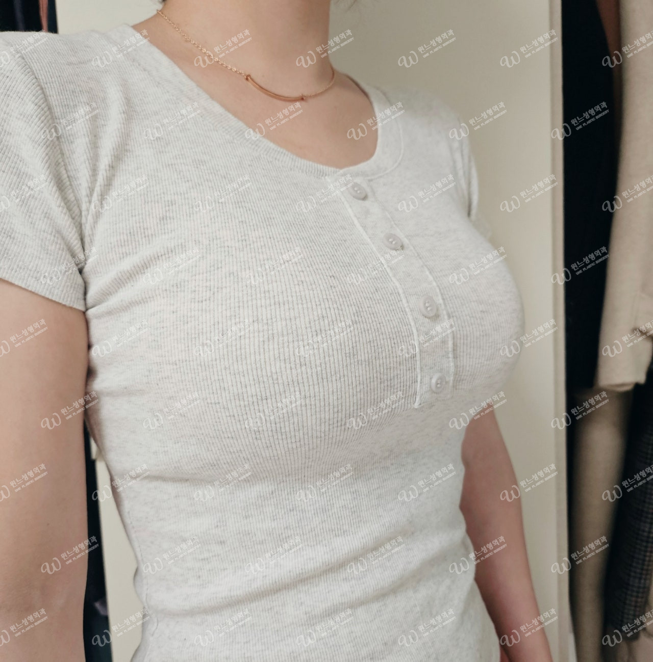 ภาพด้านหน้า 1 เดือนหลังเสริมหน้าอกที่ UNE Plastic Surgery ภาพด้านหน้า 1 เดือนหลังเสริมหน้าอกที่ UNE Plastic Surgery