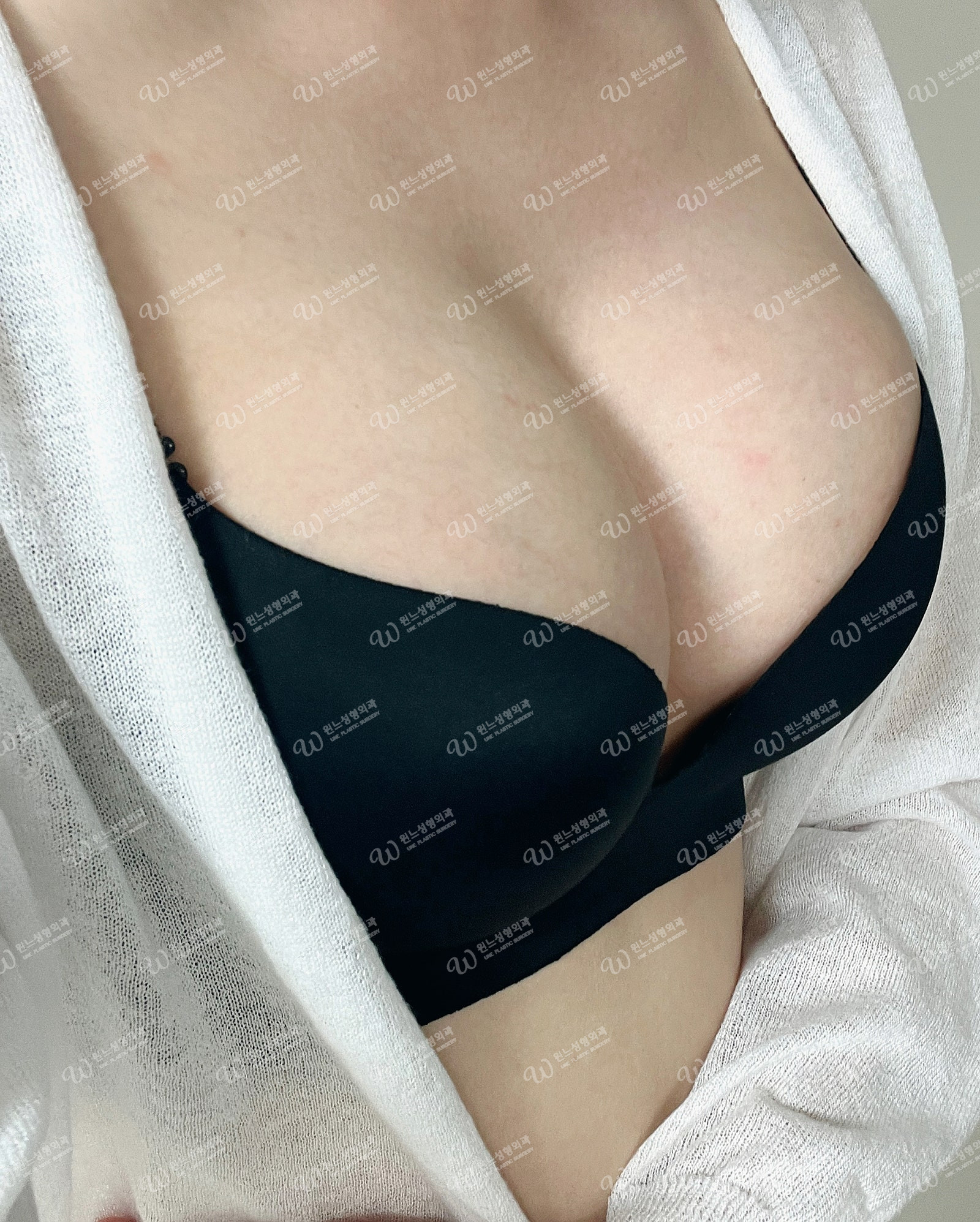 ผลลัพธ์ 2 เดือนหลังเสริมหน้าอกที่ UNE Plastic Surgery ผลลัพธ์ 2 เดือนหลังเสริมหน้าอกที่ UNE Plastic Surgery