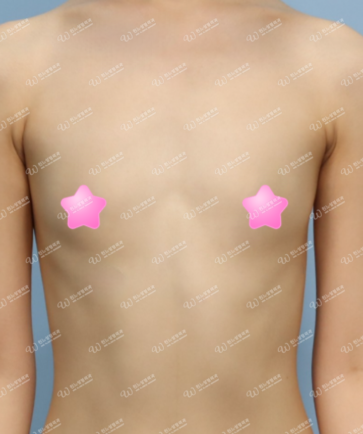 ภาพด้านหน้าก่อนผ่าตัดหน้าอกที่ UNE Plastic Surgery ภาพด้านหน้าก่อนผ่าตัดหน้าอกที่ UNE Plastic Surgery