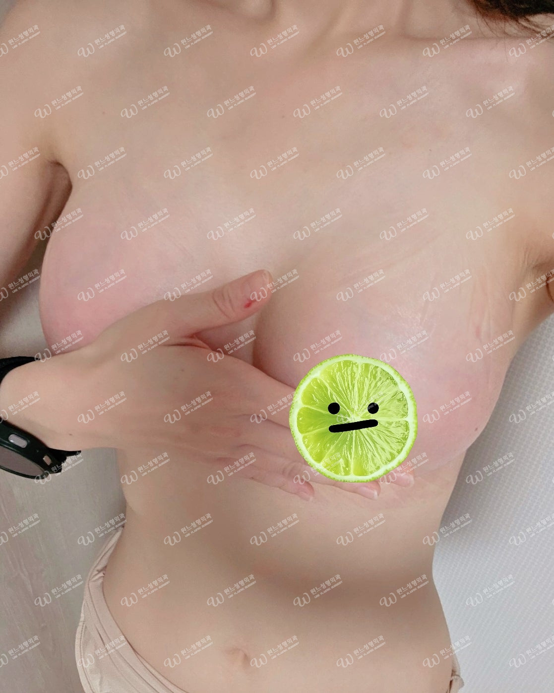 가슴수술후기 - 가슴수술 1달차 경과, 캡스케어 4회 후 촉감·모양 만족 후기 | 윈느 성형외과 김의건 원장님 대표 사진