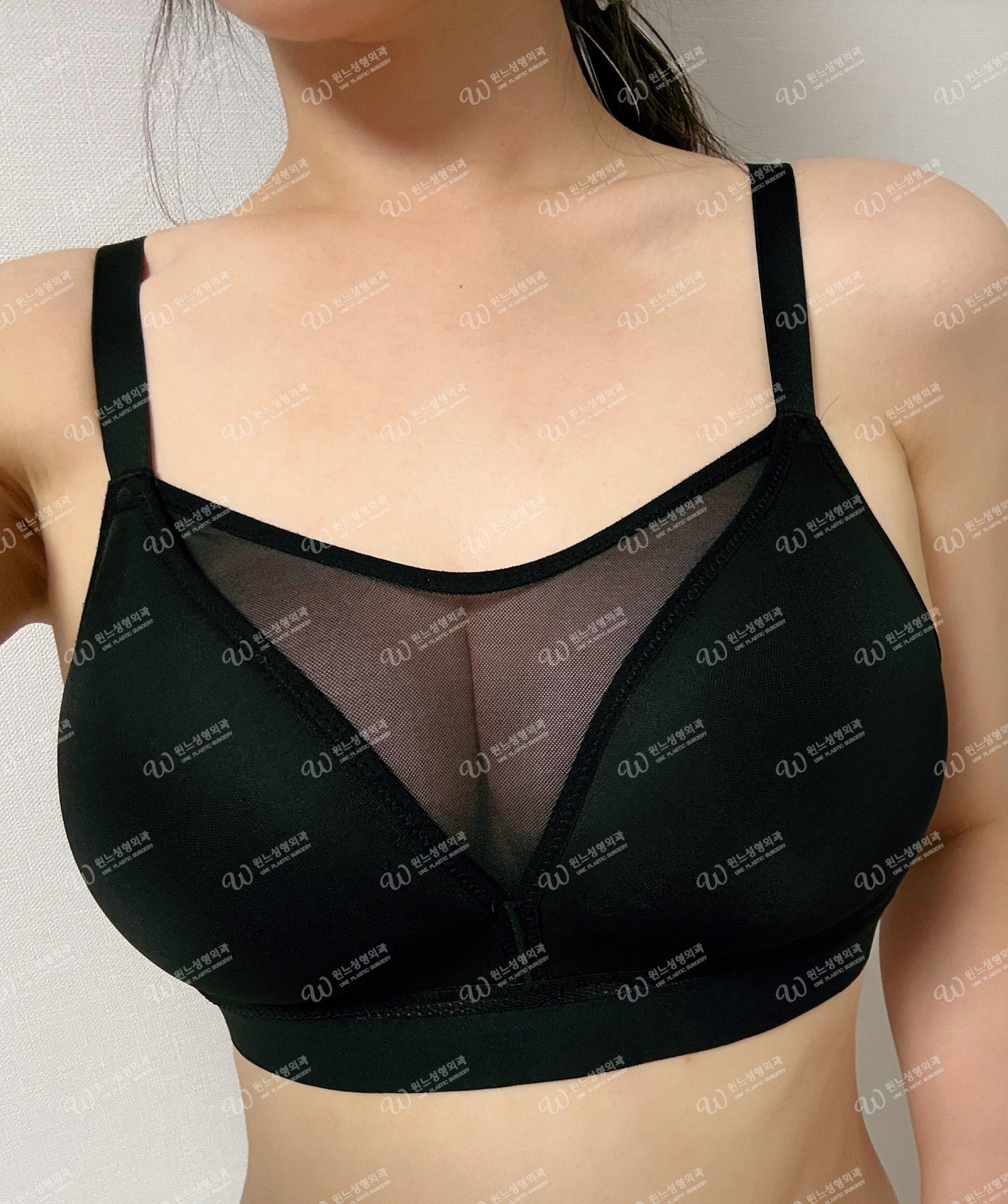 가슴 재수술 후 예뻐진 모양 1달차 가슴 재수술 후 예뻐진 모양 1달차