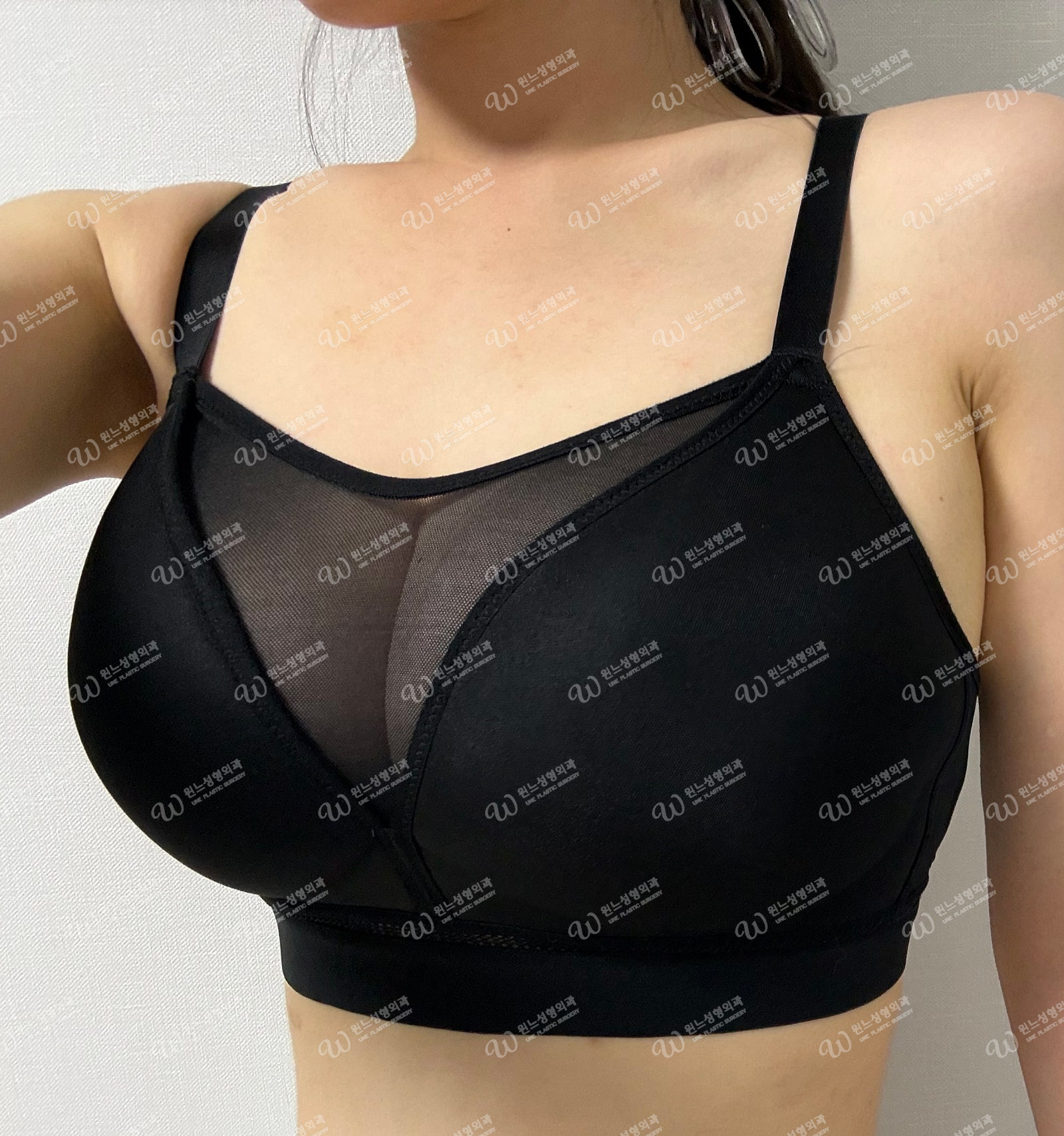 가슴 재수술 후 예뻐진 모양 1달차 가슴 재수술 후 예뻐진 모양 1달차