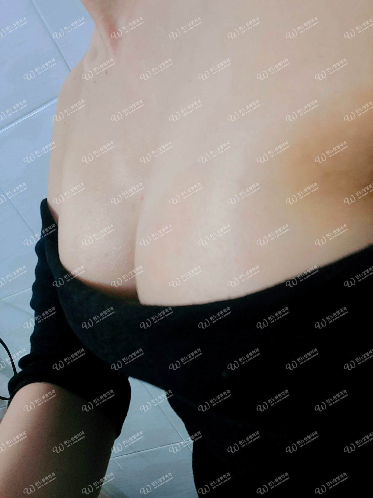 ภาพด้านหน้า 1 เดือนหลังเสริมหน้าอก ภาพด้านหน้า 1 เดือนหลังเสริมหน้าอก