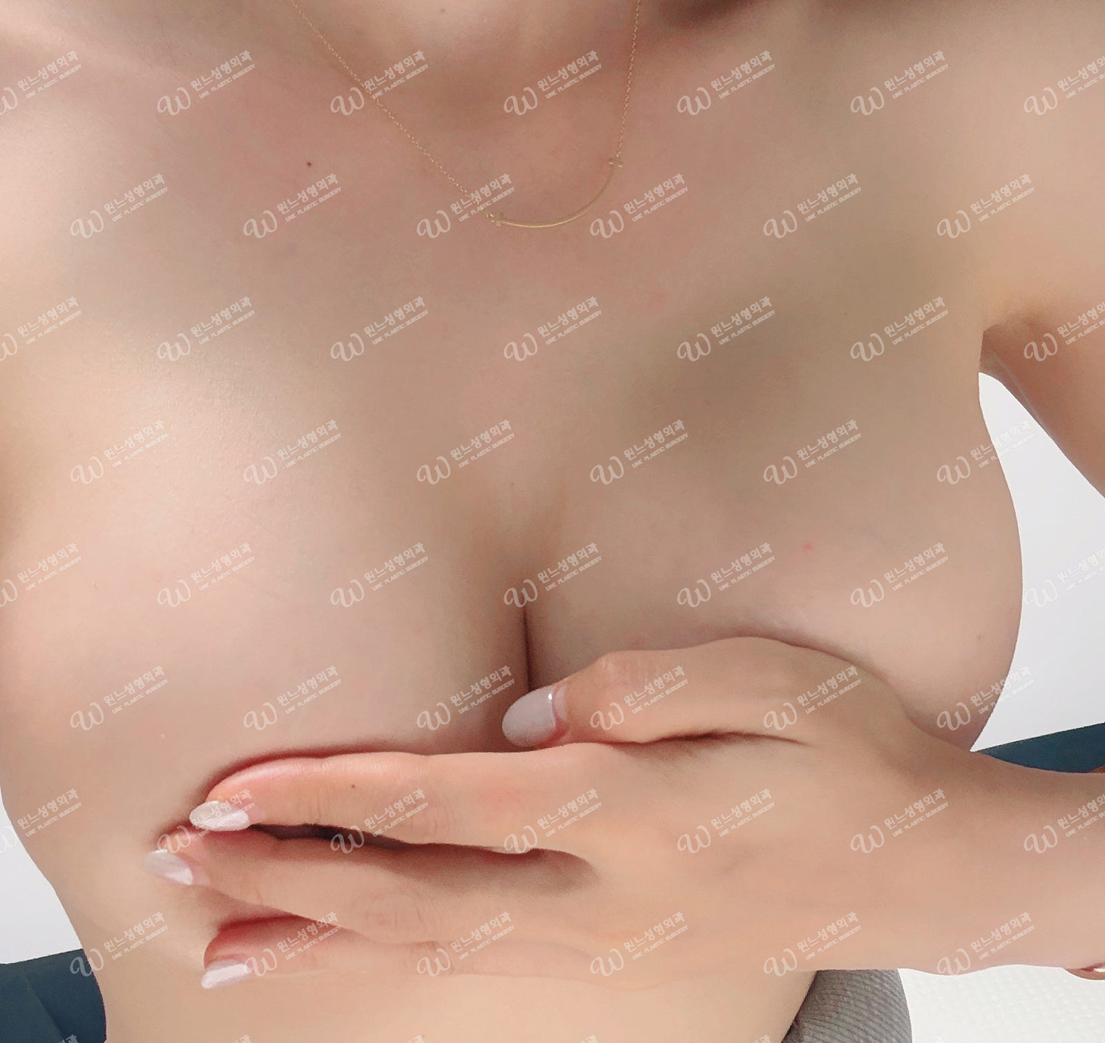 겨드랑이절개 1달차 가슴 모양 겨드랑이절개 1달차 가슴 모양